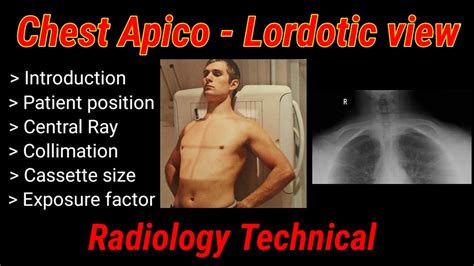 apicolordotic view treatment|Chest (AP lordotic view) .